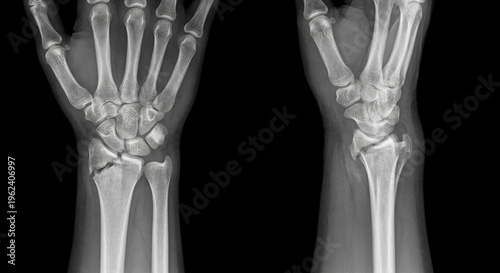 X-ray radiograph of a human wrist bone fracture showing a distal radius break in anterior-posterior and lateral views.