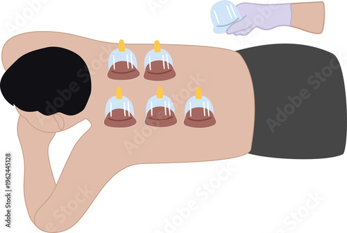 traditional medication treatment bekam