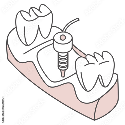 A dental model illustration showing a single implant procedure between two natural healthy teeth