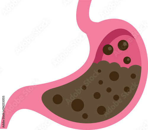 Human stomach organ filled with brown contents representing the digestion of food