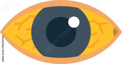 Eye with yellow sclera indicating jaundice or liver disease