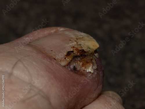 Close-up of infected ingrown toenail with inflammation and wound detail, perfect for medical, healthcare, or hygiene concepts illustrating pain, treatment, and foot care issue