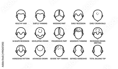 Illustration of male hair loss patterns with progressive stages