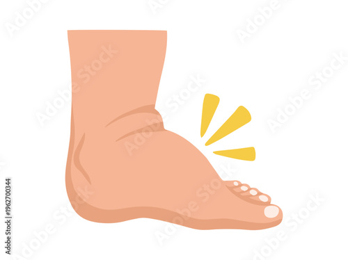 Edema or Swollen Foot Illustration

