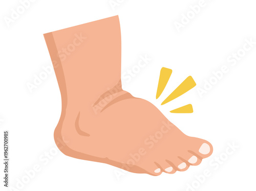 Edema or Swollen Foot Illustration
