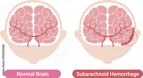 Subarachnoid hemorrhage comparison with normal brain medical illustration(English Labels)