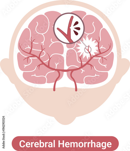 Cerebral hemorrhage medical illustration brain bleeding diagram(English Labels)