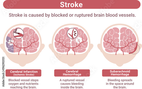 Stroke types medical infographic brain infarction cerebral hemorrhage subarachnoid hemorrhage explanation(English Labels)