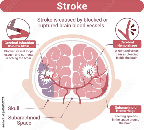 Stroke Types Medical Illustration(English Labels)