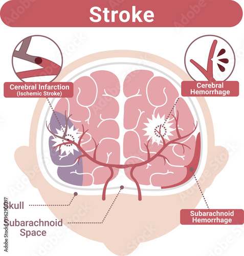 Stroke Types Medical Illustration(English Labels)