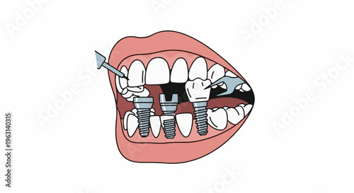 Dental implants being placed in mouth with tools