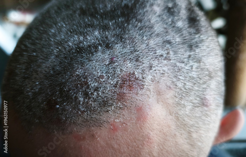 Photography Closeup of scalp with seborrheic dermatitis, red inflamed patches and dry flaky