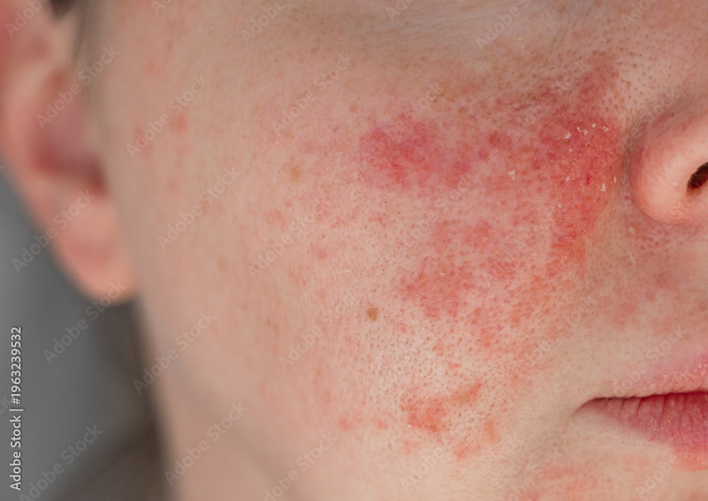 Obraz premium Close-up of a young womans face with visible skin irritation and redness. Inflamed, dry, and textured skin. Concept of sensitive skin, allergy, inflammation, and skincare problems