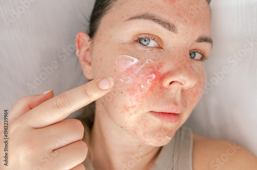 woman applying cream to irritated and inflamed facial skin with visible redness. Sensitive and problematic skin with dryness and imperfections. Dermatology, skincare treatment, and self-care concept.