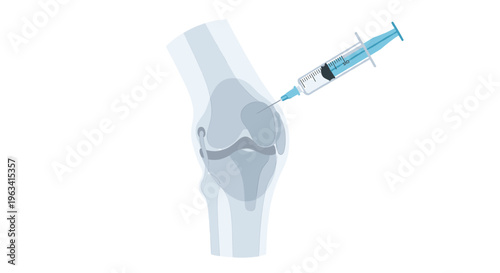 A transparent human knee joint is depicted with a syringe injecting blue fluid into its upper part against a white background.