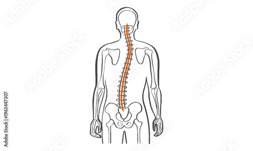 Scoliosis spine deformity