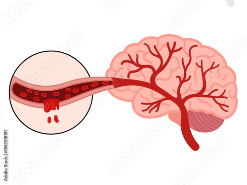 Brain vessel blockage showing clot and red cells in artery