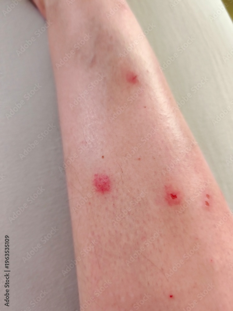 Fototapeta premium Close-up of bed bug bites on human leg. Allergic reaction to bed bug bites on skin. Multiple red, inflamed bites on lower leg from an insect infestation.