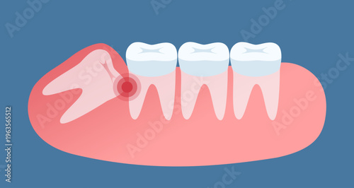 A wisdom tooth grows, flat color illustration. Impacted wisdom tooth for dentistry and dental surgery in flat style vector illustratio