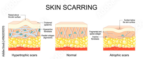 Skin scarring. Comparison of Normal skin surface, Hypertrophic scars and Atrophic scars