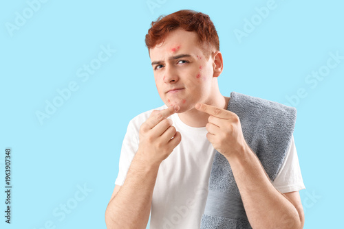 Teenage boy with acne squis...