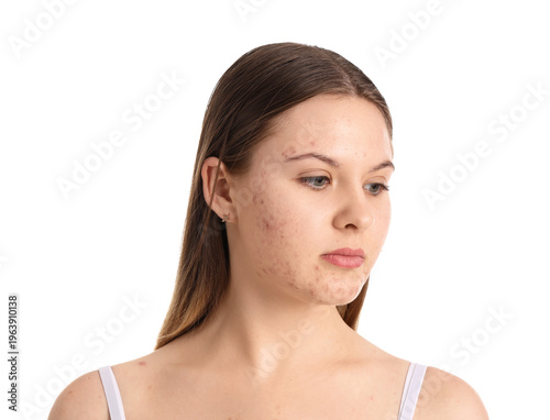 Teenage girl with acne prob...