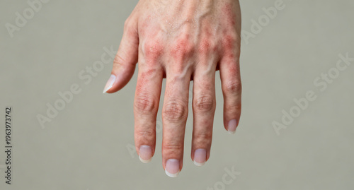 A close-up of a hand with red, irritated skin and visible veins, set against a neutral gray background, conveying discomfort or dryness.