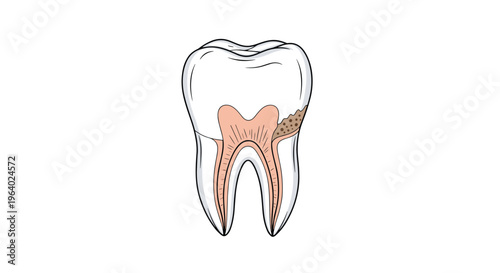 Detailed anatomical diagram of a human molar tooth showing internal structures like enamel dentin pulp and a large cavity caused by decay.