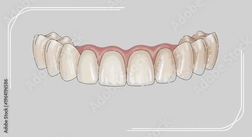 A dental bridge with visible cracks on the enamel surfaces of the teeth