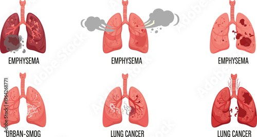 Emphysema, Urban Smog, and Lung Cancer Effects on Lungs, Showing Damage from Air Pollution and Respiratory Diseases