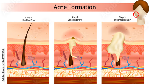 Для ИнтернетаAcne Formation Process Medical Illustration Skin Layers Pore Blockage Sebum Inflammation Diagram. Step by Step Acne Development Infographic Healthy Pore Clogged Pore Swollen Pore Skin Ana