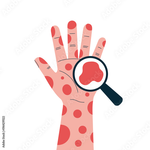 A hand with red spots is being examined with a magnifying glass