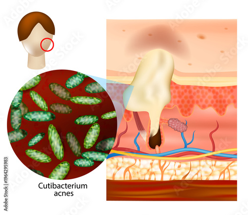 Cutibacterium Acnes Bacteria in Skin Pore Medical Illustration Acne Formation. Acne development in human skin with a cross section of a hair follicle and sebaceous gland. 