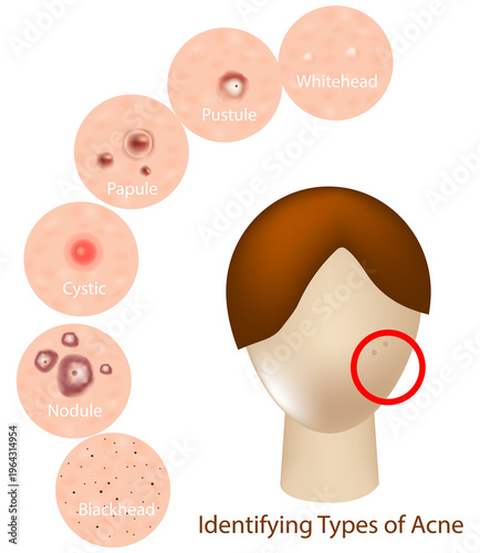 Medical infographic illustrating different types of acne on human facial skin, including whitehead, blackhead, papule, pustule, cyst, and nodule. Dermatology Acne Types