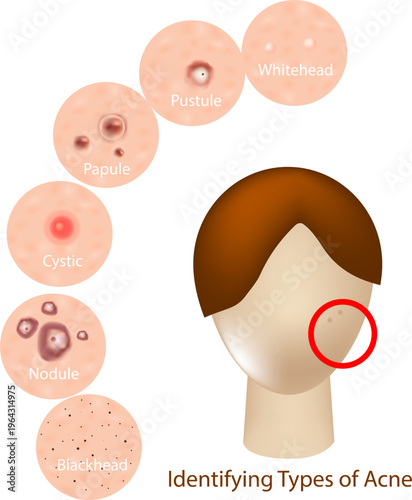 Medical infographic illustrating different types of acne on human facial skin, including whitehead, blackhead, papule, pustule, cyst, and nodule. Dermatology Acne Types