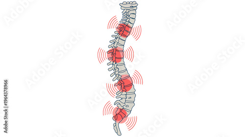 Spine with red highlighted areas indicating pain or inflammation along vertebrae column