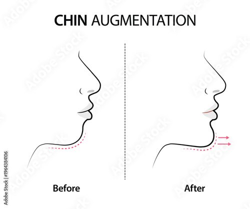 Chin augmentation simple diagram. Jawline surgery. 