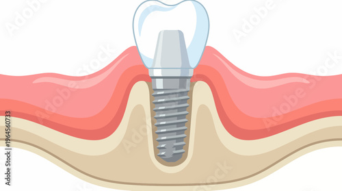 This image features a detailed dental implant graphic, showcasing its placement in the gum line to improve patient understanding of dental procedures and treatment.