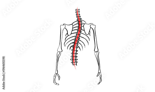 Scoliosis spine deformity