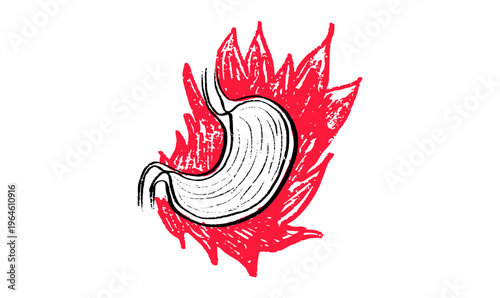 Gastroesophageal reflux pain