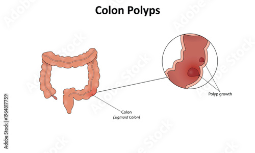 Colon polyps vector illustration