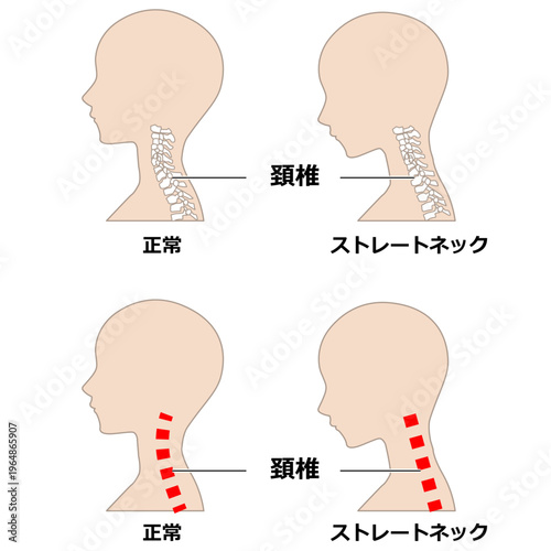 ストレートネック