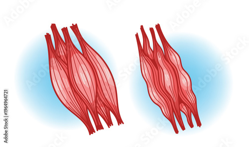 Muscle Loss vs Healthy Muscle Comparison Illustration