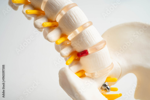 Spinal nerve and bone, Lumbar spine displaced herniated disc fragment, Model for treatment medical in the orthopedic department.