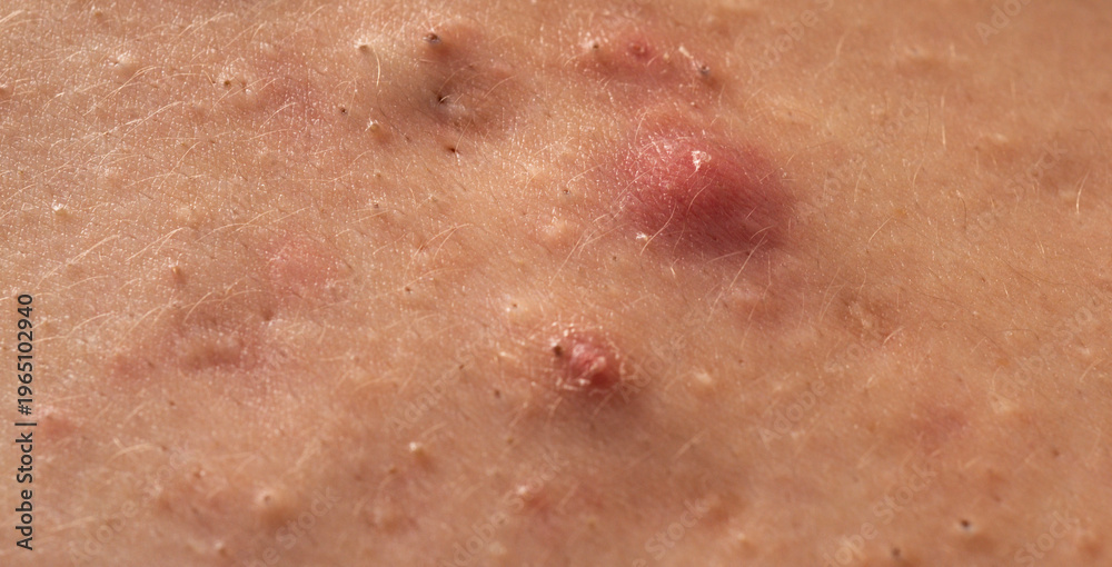 Fototapeta premium Close up acne on skin. Dermatology concept with acne skin pores. Skin rash texture with acne. Irritated acne skin.
