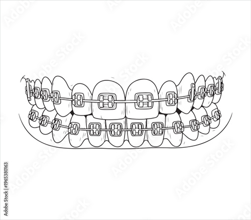 Illustration of metal braces attached to teeth for orthodontic treatment
