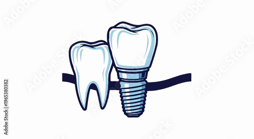 Stylized illustration of a natural tooth and a dental implant