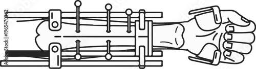 Line art shows a hand with a medical brace, wires, and pins attached
