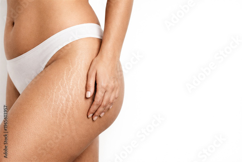 woman touching hip with stretch marks. Skin condition and body positivity concept. Real skin texture without retouching. Beauty acceptance and self love after pregnancy or weight gain