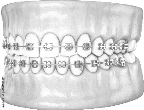 Medical orthodontic treatment halftone design concept with dots texture for dental surgery and stomatology clinic services.